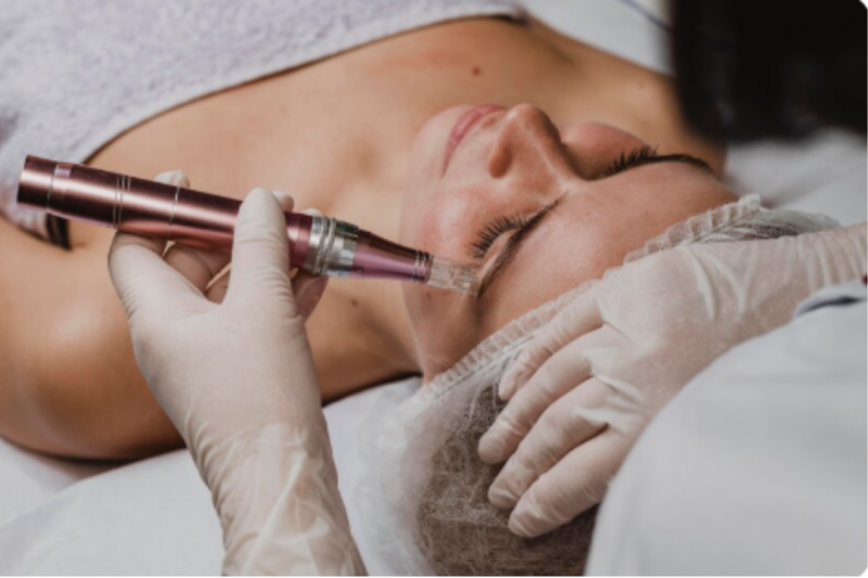 Microagulhamento para Rejuvenescimento: Como Funciona e Quais São os Benefícios Microagulhamento para Rejuvenescimento: Como Funciona e Quais São os Benefícios