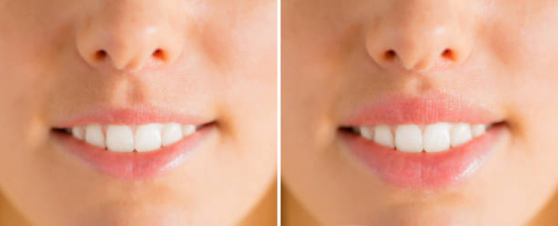 Aplicação Botox Marcar São Bento - Aplicação de Botox nos Lábios