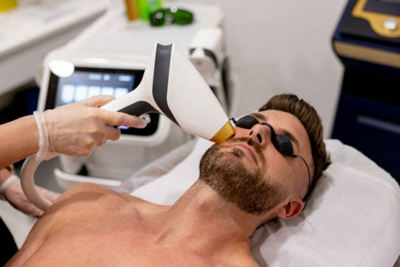 Depilação a Laser para Barba Marcar Cidade Industrial - Depilação a Laser para Acabar com Os pelos