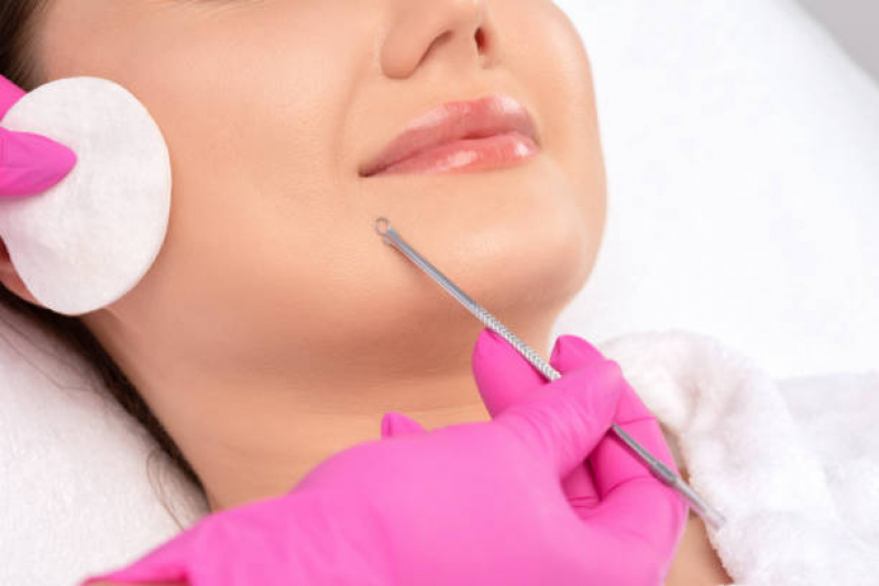 Limpeza Facial com Extração de Cravos Estoril - Limpeza Facial Profissional