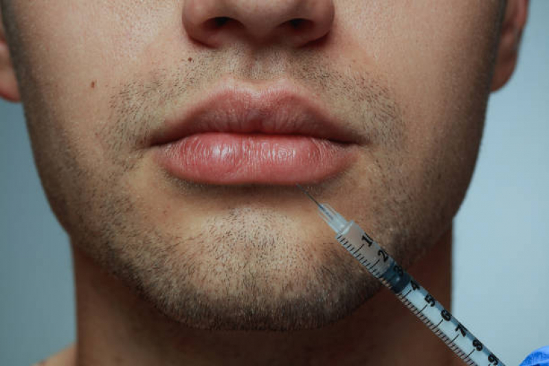 Onde Faz Preenchimento Labial Masculino Carmo - Preenchimento de Lábios
