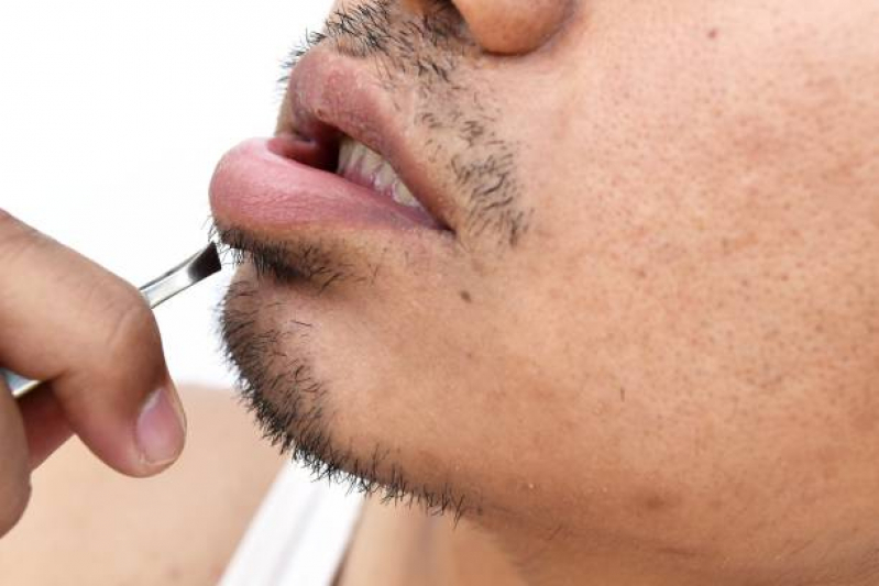 Preenchimento Labial Masculino Marajó - ácido Hialurônico para Lábios