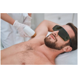 depilação a laser masculina marcar São Bento