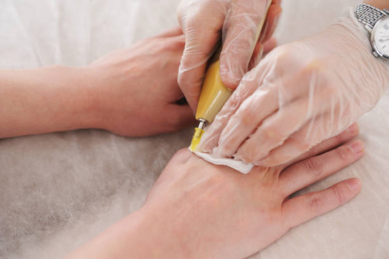 Tratamento para Mãos Envelhecidas Marcar Nova Cintra - Tratamento para Rejuvenescer as Mãos