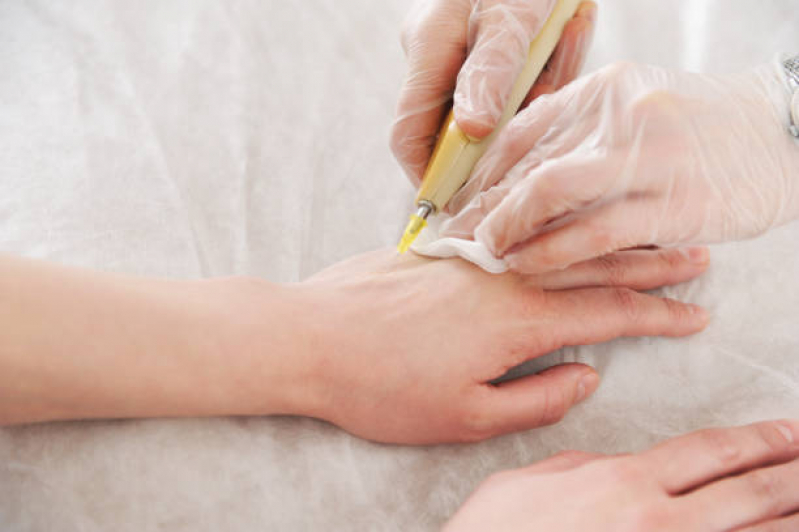 Tratamento para Rejuvenescimento das Mãos Marcar Santa Lúcia - Tratamento para Mãos Envelhecidas
